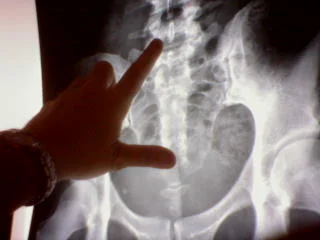 A finger tracing the spine on an X-ray